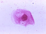    Neisseria meningitidis - ,               75 